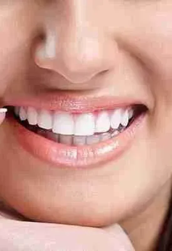 Veneers